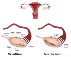 PCOS Fertility and Diet