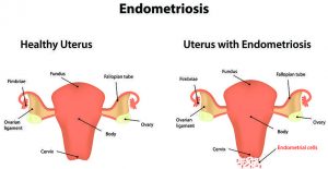 Endometriosis, Fertility