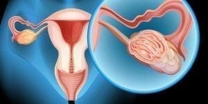 Ovarian Tissue Transplants to Help Conceive After Cancer 2