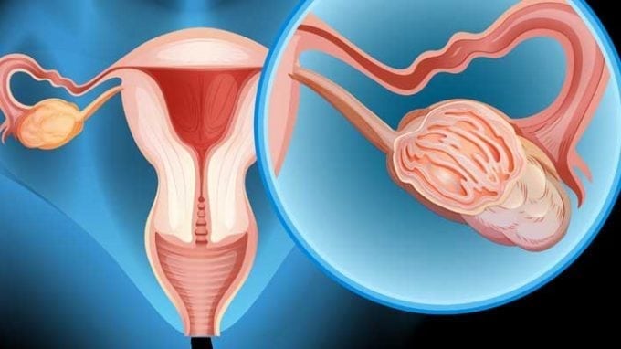 Ovarian Tissue Transplants to Help Conceive After Cancer