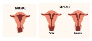 The Impact a Septate Uterus Has on Women’s Fertility 