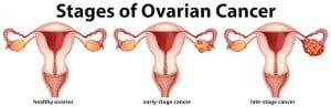 Understanding Ovarian Cancer and Your Fertility