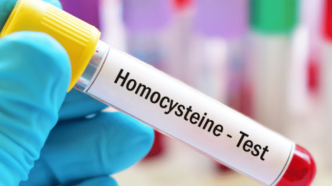 What High Homocysteine Levels Mean for Your Fertility