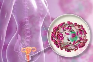 PCOS and Bacterial Vaginosis: Is There a Link?