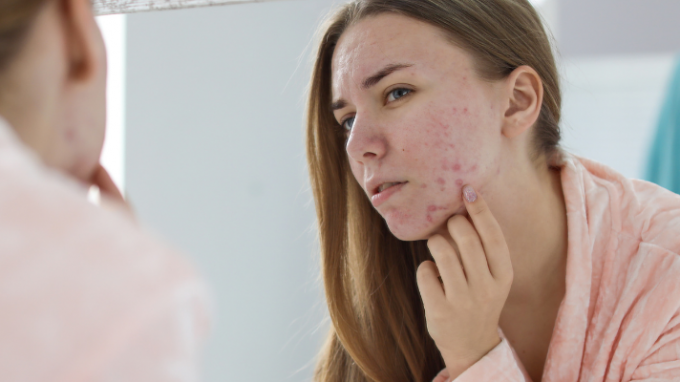 PCOS and Acne: Everything You Should Know