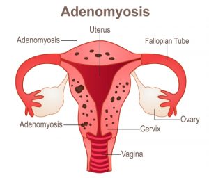 Adenomyosis and IVF, What You Should Know
