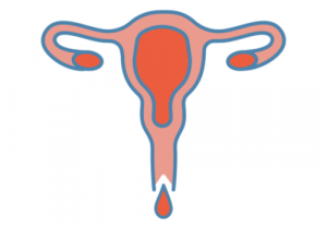 Everything You Want to Know About Ectopic Pregnancy