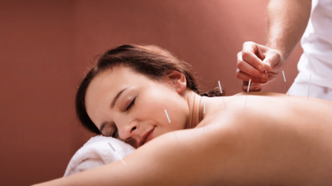 The Role of Acupuncture for Women with PCOS