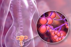 The Link Between Candida and Endometriosis 1