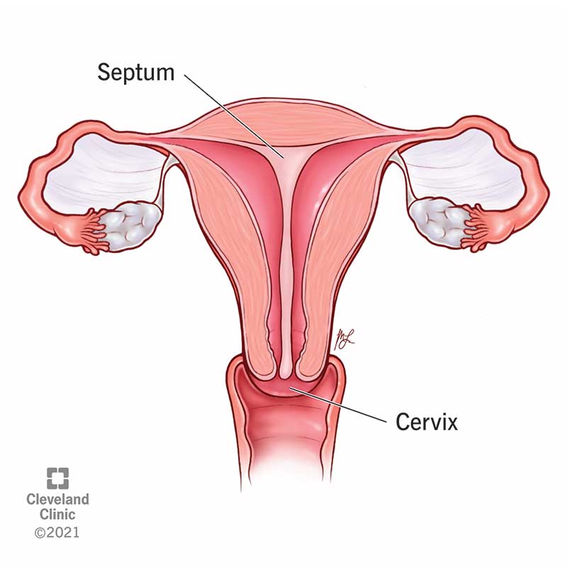 Understanding A Septate Uterus And The Increased Risk For Miscarriage