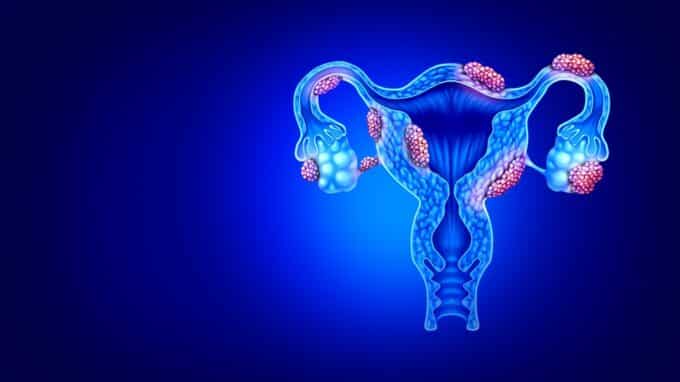 New Treatment Approaches In The Fight Against Endometriosis