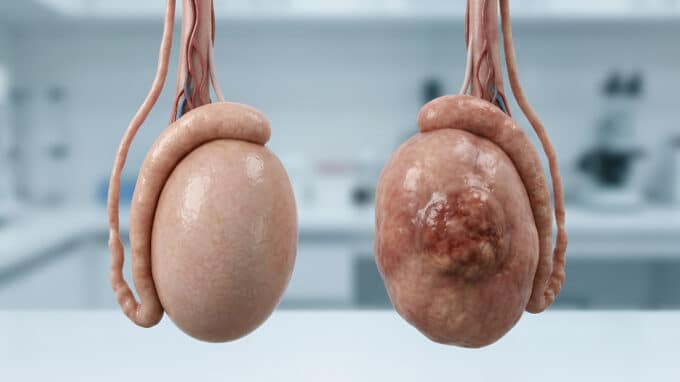 Fertility After Cancer: Frozen Testicular Tissue Transplanted Back for the First Time